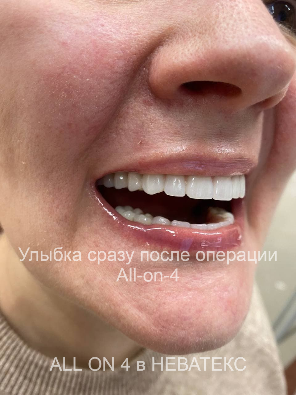 улыбка пациента после имплантации all-on-4 улыбка пациента после имплантации all-on-4